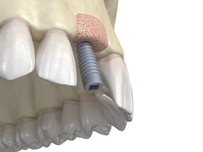 3D medical illustration of a bone graft for a dental implant
